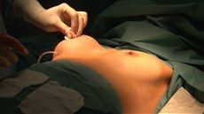 Operace zvětšení prsou