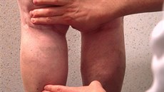 Mezi ob�ti k�e�ových �il pat�í �asto lidé s nadváhou.