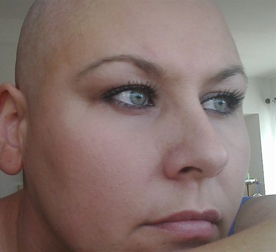 Pi chemoterapii jsem ztratila vlasy.