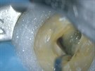 operace zubu