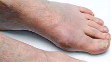 Dna na sebe obvykle upozorní nateklým palcem na noze.