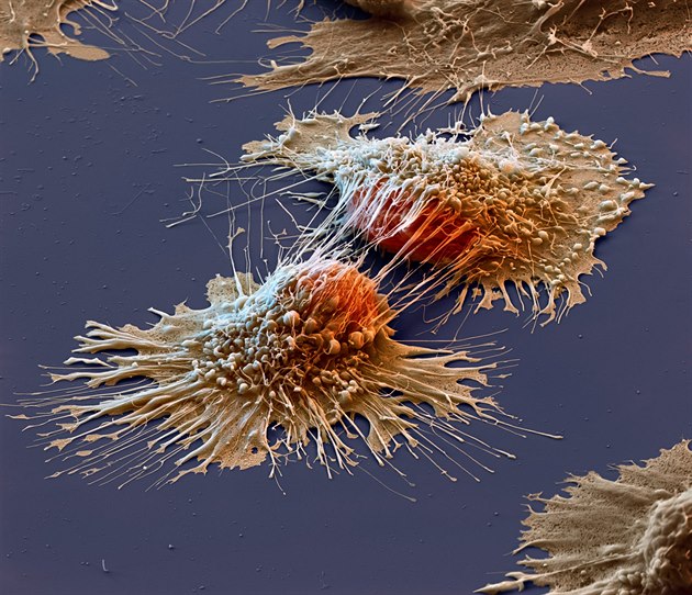Kolorovaný snímek rakovinových bunk z elektronového mikroskopu