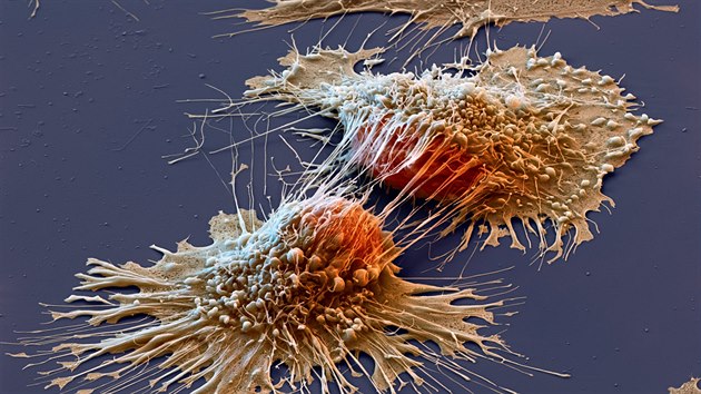 Kolorovaný snímek rakovinových buněk z elektronového mikroskopu
