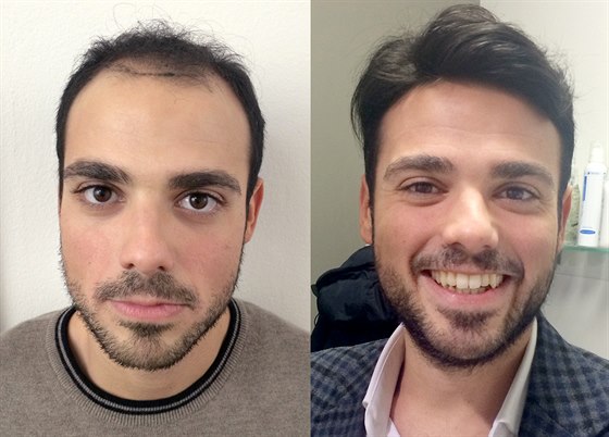 Ukázka před a po aplikaci vlasové náhrady RealHair