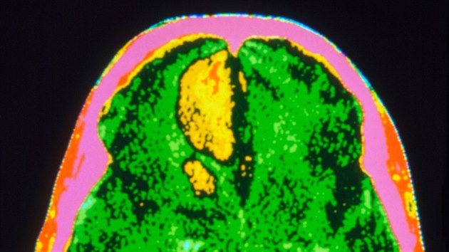 Snmek CT ukazujc subarachnoidln krvcen (lut tvar uprosted). Krvcen bylo zpsobeno prasknutm tepenn vdut.
