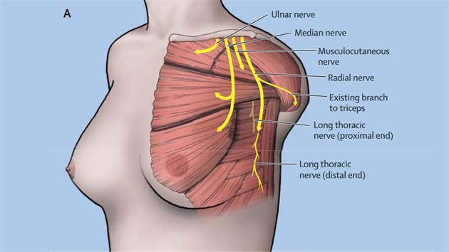 Znzornn napojen na existujc nervy ve svalech