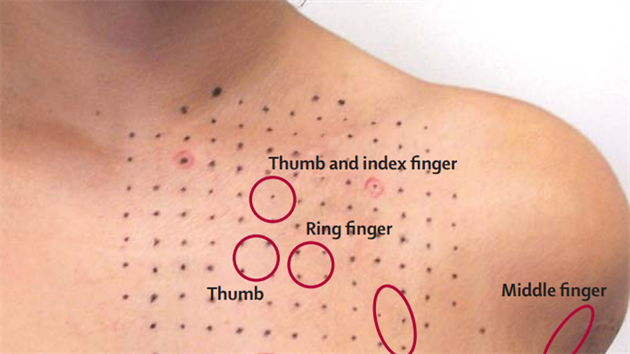 Mapa oblast, kam jsou pesmrovny vjemy z dotek prst ztracen konetiny.