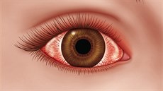 P�i zán�tu spojivek dochází k jejich p�ekrvení - oko zarudne.