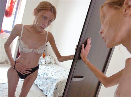 Anorexii podlehla v roce 2010 francouzská modelka Isabelle Caro. Její smrt rozpoutala celospoleenskou diskuzi.