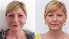 Botox