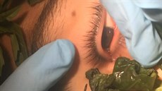 Lékai vyndali z oka 17letého mladíka tícentimetrovou larvu.