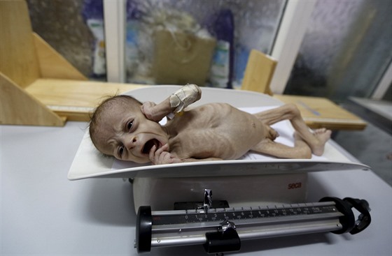 estimsíní podvyivený chlapeek Ali Mohammed al-Tavarí v porodnici v Jemenu...