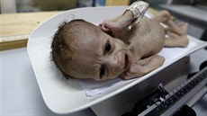 estimsíní podvyivený chlapeek Ali Mohammed al-Tavarí v porodnici v Jemenu...