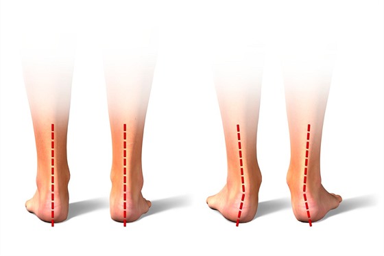 Na snmku jsou vlevo vidt zdrav nohy a vpravo vboen pata.
