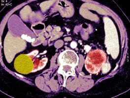Snímek z poítaové tomografie, kde je vidt nádor ledviny (lutozelená barva)....