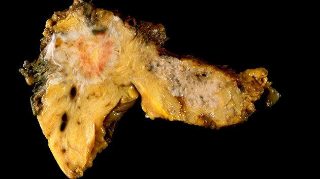 Karcinom pankreatu je vidt jako bl tk vlevo nahoe a vpravo uprosted. Rakovina slinivky pat mezi nejnebezpenj typy ndor. 