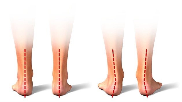 Na snmku jsou vlevo vidt zdrav nohy a vpravo vboen pata.