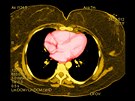 Snímek z CT obézního pacienta, lutá barva ukazuje velké mnoství tuku v tle.