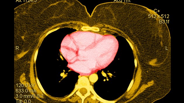Snmek z CT obznho pacienta, lut barva ukazuje velk mnostv tuku v tle.