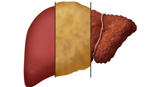 Snímek ukazuje, jak vypadají játra zdravá (vlevo), ztučnělá (uprostřed) a s cirhózou (vpravo).