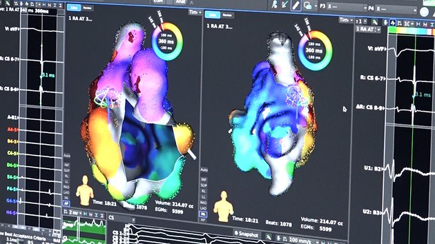 3D operace srdce