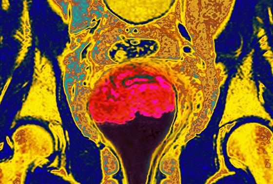 Snímek z magnetické rezonance ukazuje nález rakoviny děložního čípku (růžová...