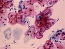 HPV infekce dloního ípku. Snímek cervikálního stru odhalující epiteliální...
