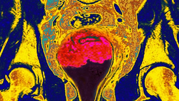 Snímek z magnetické rezonance ukazuje nález rakoviny děložního čípku (růžová barva uprostřed).