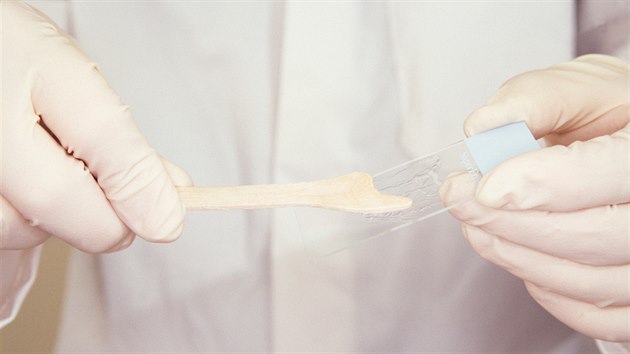 Cytologie je screeningová metoda vyšetření rakoviny děložního čípku (ilustrační snímek)