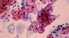 HPV infekce dloního ípku. Snímek cervikálního stru odhalující epiteliální...
