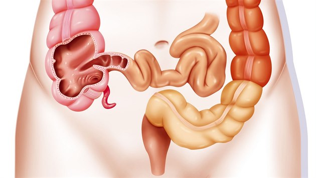 �ervovit� p��v�sek slep�ho st�eva odborn� naz�van� appendix vermiformis, je ve skute�nosti jako �erv�k vypadaj�c� sou��st tlust�ho st�eva. Pokud �lov�ka zlob�, podle zku�enost� l�ka�� mus� pry�.