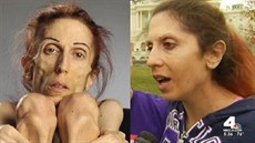 Anorekti�ka Rachael Farrokhová v kv�tnu 2015 a po p�l roce lé�ení mentální...
