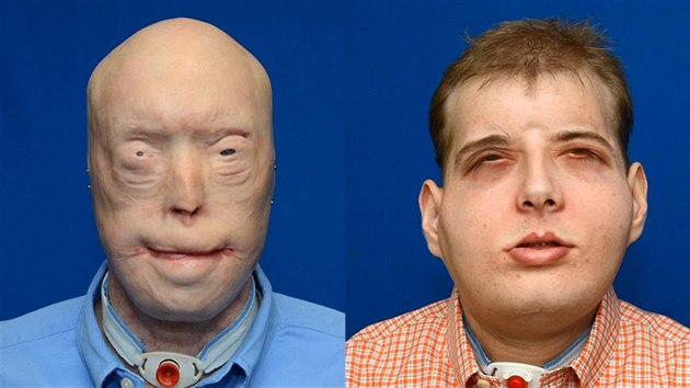 Unikátní transplantace dala hasiči novou tvář.