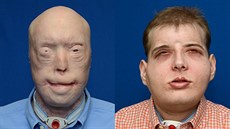 Patrick Hardison před a po tranplantaci obličeje