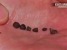 Fragmenty údajného meteoritu z Loxahatchee a rána, kterou ml zpsobit.