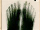 Jeden z dochovaných Dreuschuchových snímk nohou z poátk rentgenologie na...