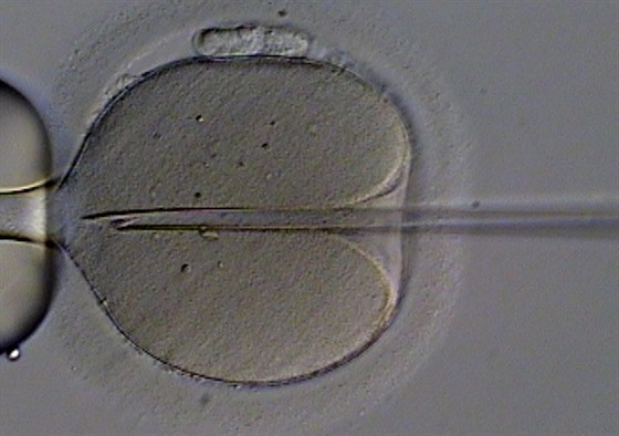 Umělé oplodnění lidského vajíčka injekcí spermie. Nejde o běžnou součást...