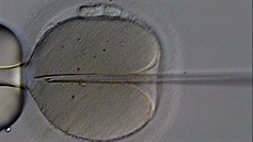 Umlé oplodnní lidského vajíka injekcí spermie. Nejde o bnou souást...