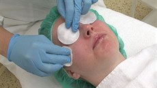 Chemický peeling