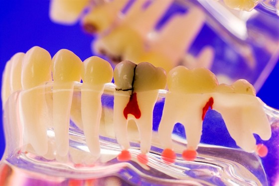 Podle stomatolog praskaj vbec nejastji takzvan mrtv zuby po...