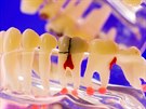 Podle stomatolog praskají vbec nejastji takzvané mrtvé zuby po...