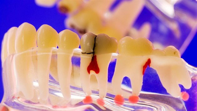 Podle stomatolog praskaj vbec nejastji takzvan mrtv zuby po endodontickm oeten, pi nm lka odstrauje nerv ze zubn den a koenovch kanlk, kter se pak zapluj speciln vpln.