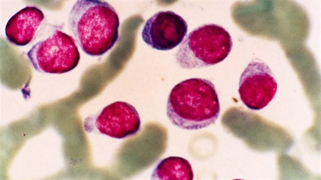 Snímek plazmatických buněk u pacienta s mnohočetným myelomem.
