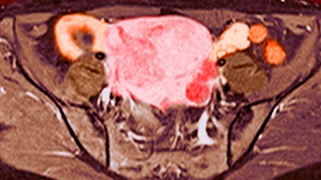 Snímek z magnetické rezonance, kde je vidět myom v děloze (růžová barva) u 48leté pacientky.