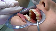 Ped prvním nasazením rovnátek je dleité dkladné vyitní zub.