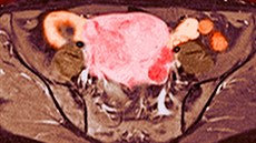 Snímek z magnetické rezonance, kde je vidět myom v děloze (růžová barva) u...