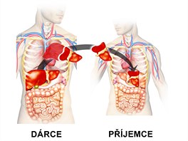 IKEM provedl svtov uniktn transplantaci jater. Transplantoval jtra...
