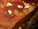 Na obrázku je ukázka identifikace defektu krčku zubu pomocí periodontální sondy...