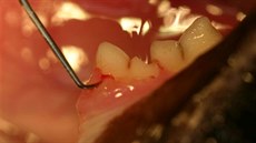 Na obrázku je ukázka identifikace defektu krku zubu pomocí periodontální sondy...