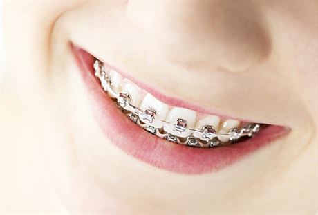 Rovnátka vyeí estetický i zdravotní problém zub.